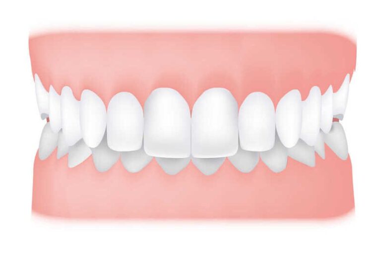 Niềng răng hô nhẹ có phải nhổ răng không?