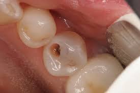 Quá trình bị sâu răng diễn ra thế nào?