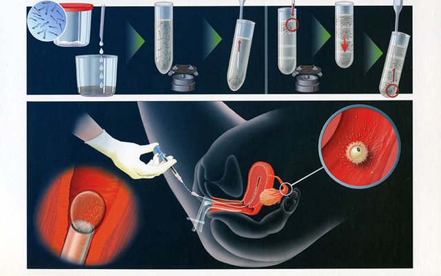 Tìm hiểu kỹ thuật bơm tinh trùng vào buồng tử cung (IUI) tại Vinmec