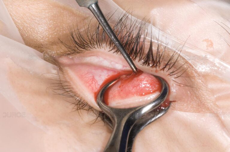 Tiểu phẫu lẹo mắt có gây biến chứng?