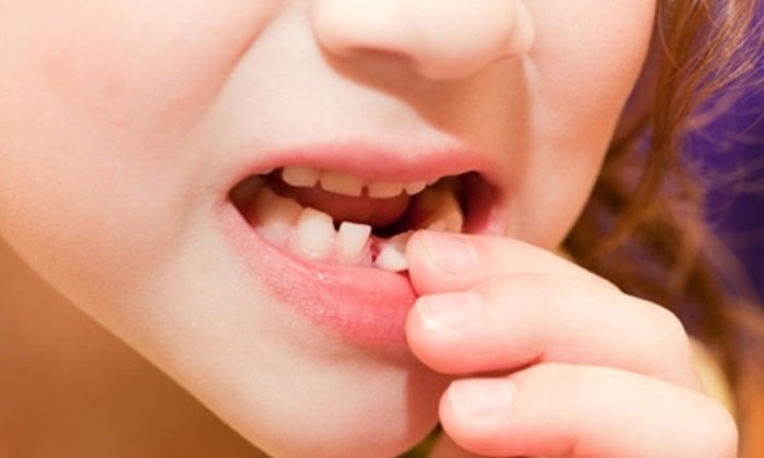 Bé 4 tuổi có nhổ răng được không?