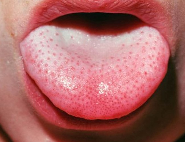 Bệnh sốt tinh hồng nhiệt (sốt Scarlet) là bệnh gì?