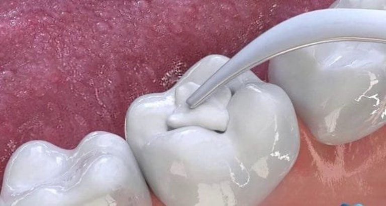 Đặt thuốc diệt tủy răng có đau không?