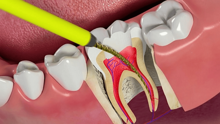 Răng đang đau có lấy tủy được không?