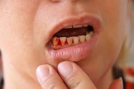 Bị chảy máu chân răng khi ngủ là do đâu?