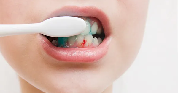 Đừng chủ quan nếu thường xuyên bị chảy máu khi đánh răng
