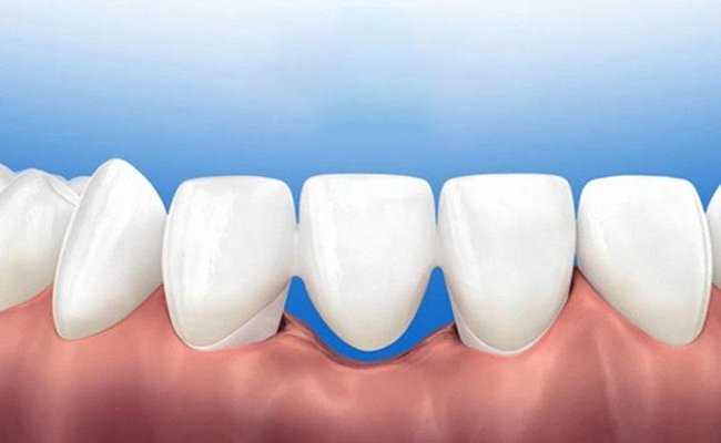 Làm cầu răng sứ có bị tiêu xương không?