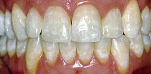 Dấu hiệu răng bị thừa fluor ở trẻ