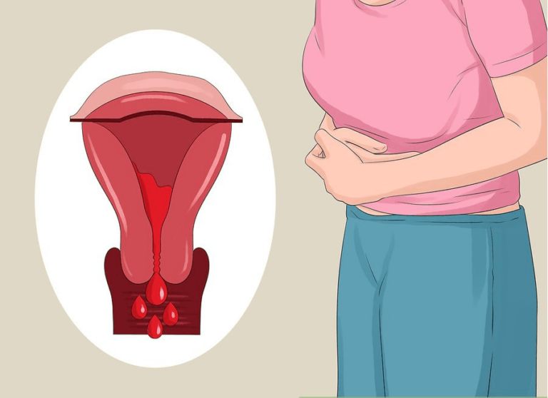 Cách giảm đau khi bị lạc nội mạc tử cung