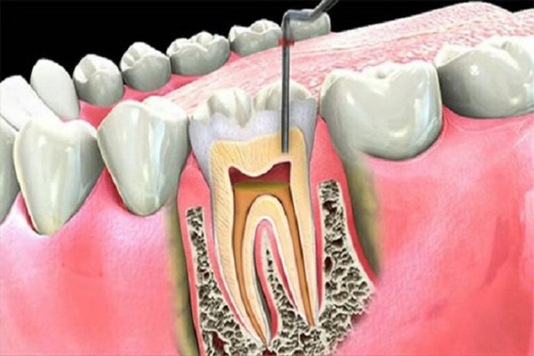 Răng lấy tủy có bị tiêu xương không?