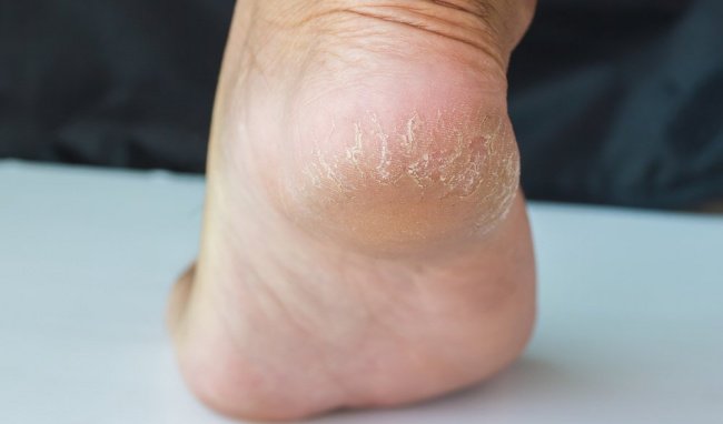 Bị nứt gót chân là thiếu chất gì?