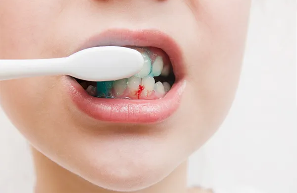 Thường xuyên bị chảy máu chân răng khi đánh răng có đáng lo?