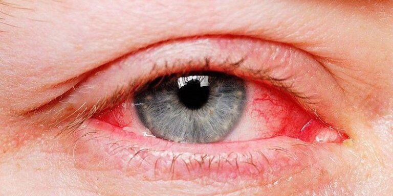 Đau mắt đỏ chữa thế nào?