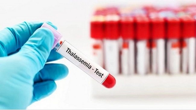 Người mang gen Thalassemia cần lưu ý gì?