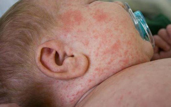 Trẻ nhũ nhi có thể mắc bệnh sốt xuất huyết không?
