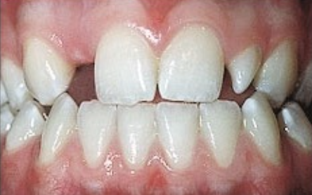 Rối loạn tạo răng có nguy hiểm?