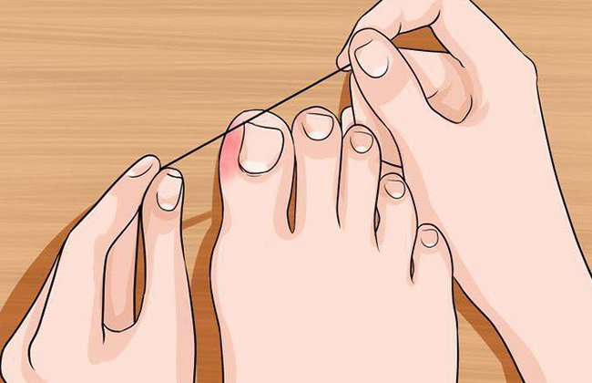 Lấy khóe móng chân bị sưng mủ có nguy hiểm?