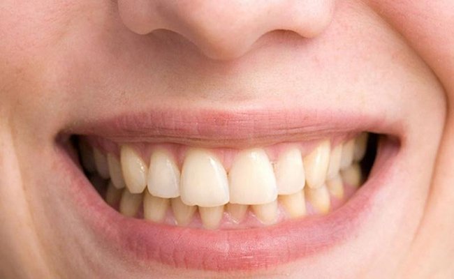 Thế nào là răng nhiễm fluor?