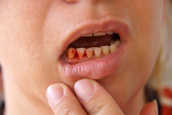 Tại sao thiếu vitamin C gây chảy máu chân răng?