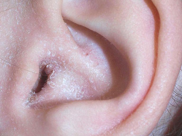 Bệnh chàm tai ở trẻ em