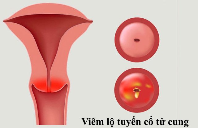 Xử lý viêm lộ tuyến cổ tử cung: nên đốt lộ tuyến hay không?