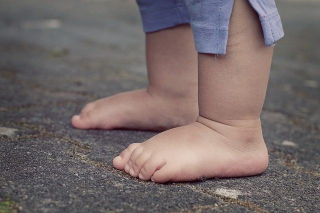 Dị tật bàn chân vẹo ở trẻ em