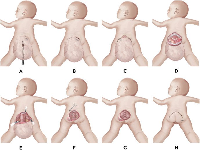 U quái vùng cùng cụt thai nhi – Sacrococcygeal teratoma  (SCT)