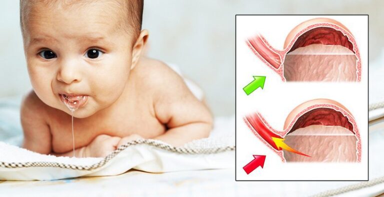 Cách xử lý chứng trào ngược của trẻ sinh non