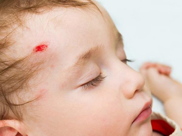Phải làm gì khi trẻ sơ sinh hoặc trẻ mới biết đi bị ngã va đập vào đầu?