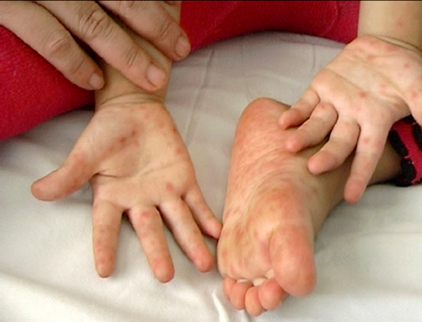 Bệnh tay chân miệng: Dấu hiệu phát hiện sớm và cách phòng tránh bệnh chân tay miệng vào mùa hè