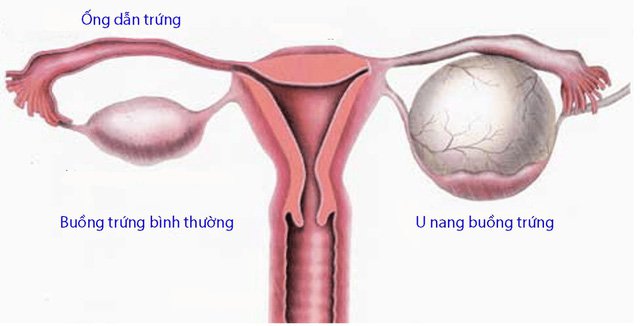 Suy buồng trứng nguyên phát: Triệu chứng, nguyên nhân và ảnh hưởng tới khả năng mang thai