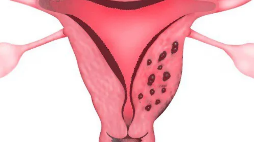 Cắt bỏ nội mạc tử cung: Những điều cần biết