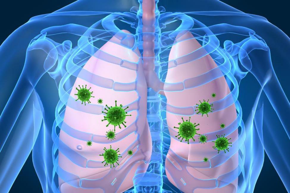 Lý do dễ bị viêm phổi do vi khuẩn sau nhiễm virus
