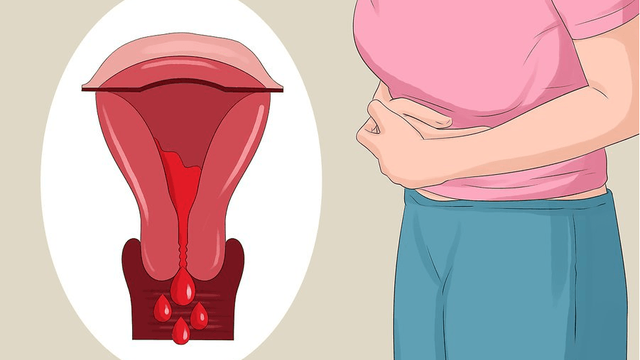 Lạc nội mạc tử cung: Khi nào nên mổ?