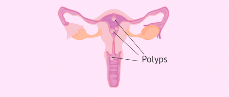 Bị polyp buồng tử cung có mang thai được không?