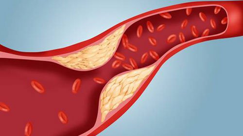 Vôi hóa mạch máu có nguy hiểm?