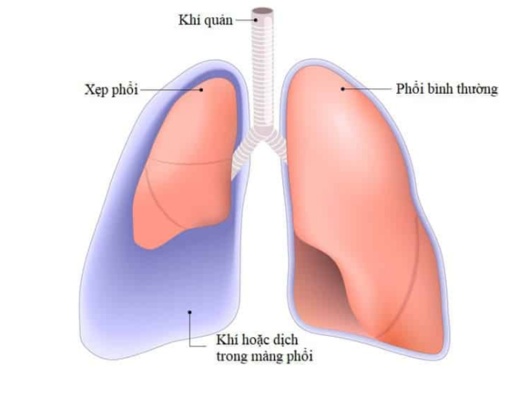 Nguyên nhân và triệu chứng xẹp phổi