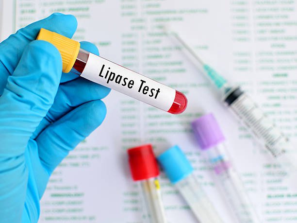 Tìm hiểu về xét nghiệm lipase trong chẩn đoán