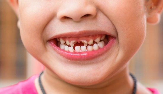 Làm thế nào khi trẻ bị sâu răng sữa?