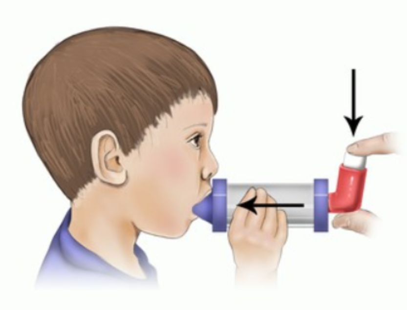 Hướng dẫn sử dụng bình xịt định liều ở trẻ