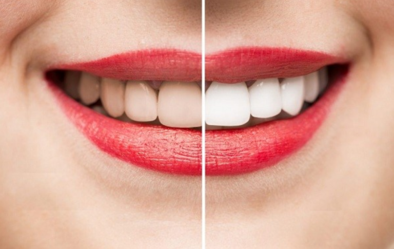 Tẩy trắng răng có an toàn?