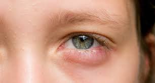 Dùng kháng sinh điều trị các bệnh ở mắt