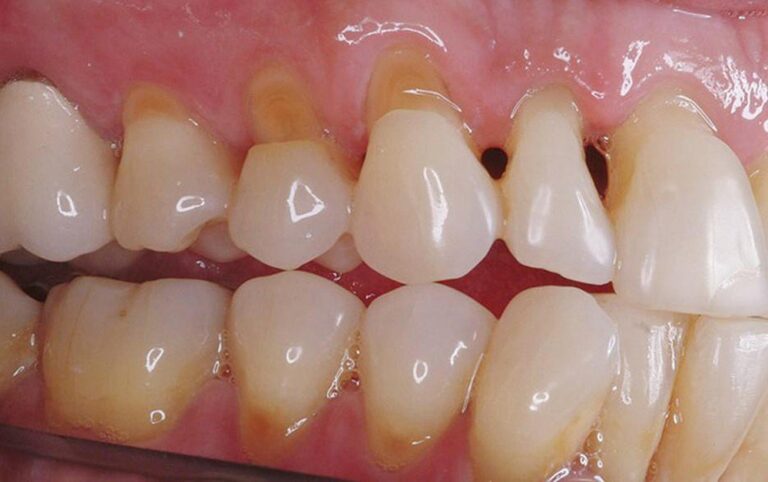 Mòn cổ răng – bệnh lý nha khoa phổ biến nhưng dễ bị bỏ qua