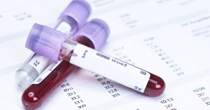 Xét nghiệm sinh hóa máu có phát hiện HIV?