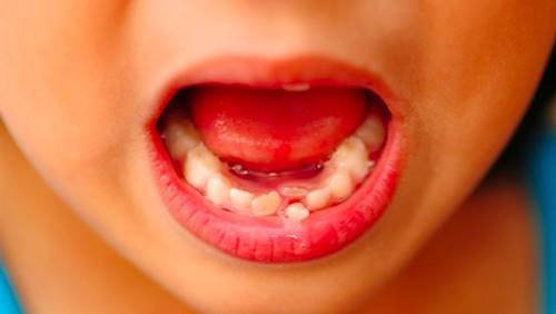 Tại sao răng sữa chưa rụng đã mọc răng mới?