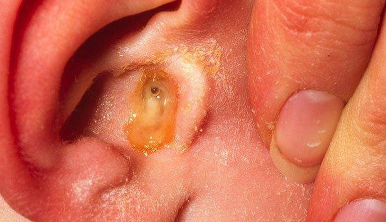 Các giai đoạn của viêm tai giữa ở trẻ em