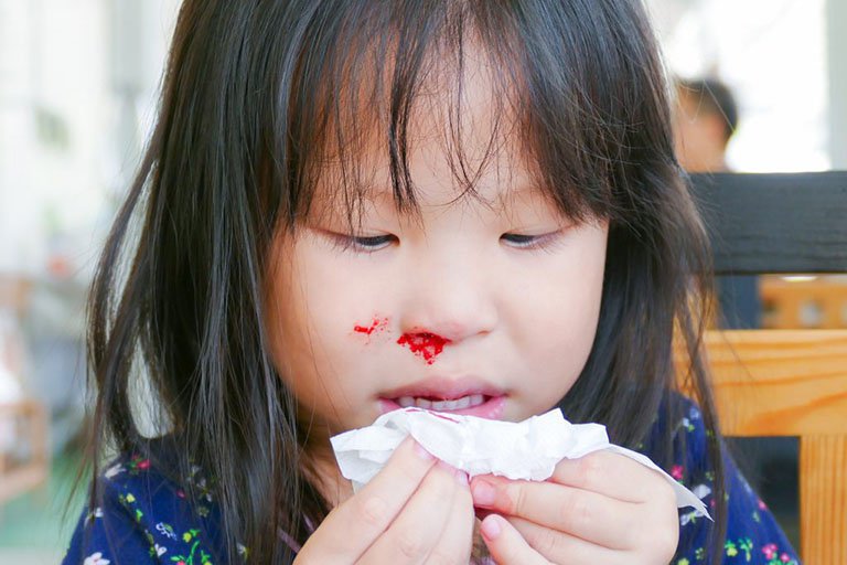 Trẻ hay chảy máu mũi là bệnh gì?