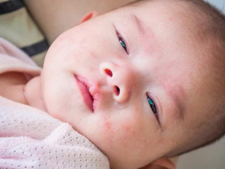 Làm gì khi trẻ sơ sinh bị viêm da cơ địa?