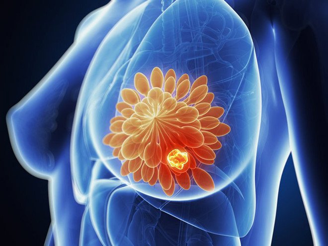Khám sàng lọc ung thư vú là khám những gì?