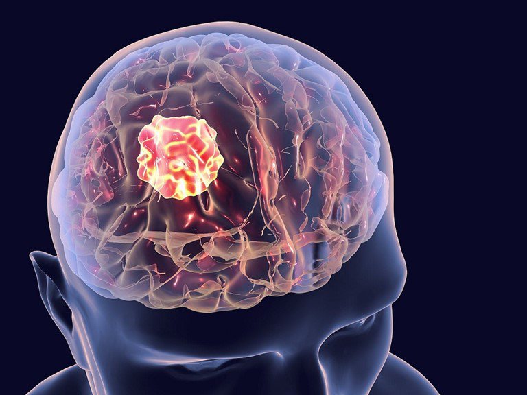 Nguyên nhân nào gây ra khối u não và tủy sống ở người lớn?